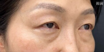 AI Beauty Clinicの目元・クマ・眉下・涙袋整形の症例写真[ビフォー]