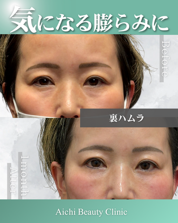 あいちビューティークリニック栄本院の目元・クマ・眉下・涙袋整形の症例写真