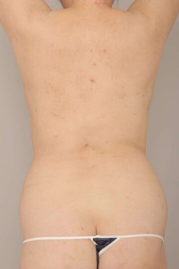 Mods Clinic (モッズクリニック)の脂肪吸引の症例写真[ビフォー]