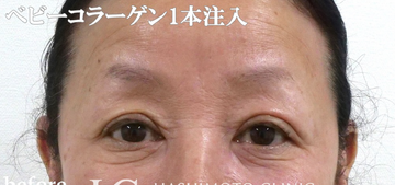 静岡美容外科橋本クリニックの目元・クマ・眉下・涙袋整形の症例写真[ビフォー]