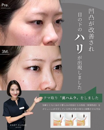 KNOT CLINIC AOYAMAの目元・クマ・眉下・涙袋整形の症例写真
