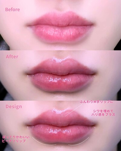 【涙袋ヒアルロン酸】の症例写真