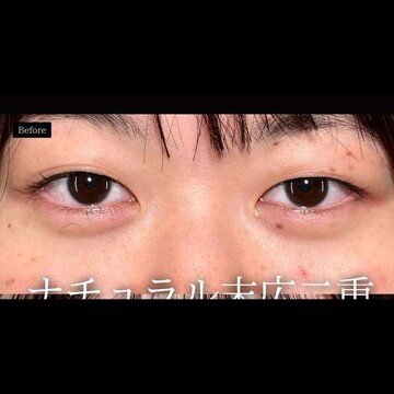 PRISM Beauty Clinicの二重の症例写真[ビフォー]