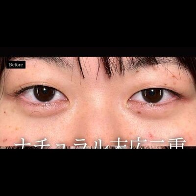 二重埋没で人生激変‼️の症例写真[ビフォー]