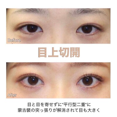 蒙古襞を解除し自然な平行型二重にの症例写真