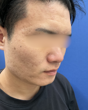 ニキビ跡の治療(ダーマペンエクソソーム、ACRS)の症例写真[アフター]