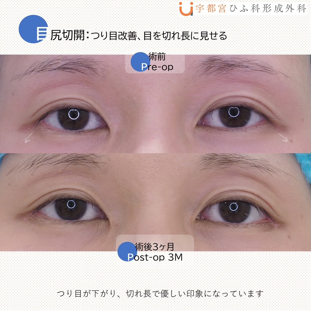 目頭切開・目尻切開の症例写真・画像 _ 目尻切開と目頭切り開の違い – ZGOJBW