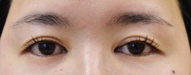 他院目頭切開術後修正の症例写真[ビフォー]
