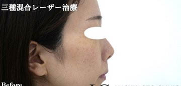 静岡美容外科橋本クリニックのほくろ除去・あざ治療・イボ治療の症例写真[ビフォー]
