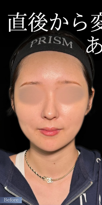 PRISM Beauty Clinicのしわ・たるみ整形(注入、糸、フェイスリフト)の症例写真[ビフォー]