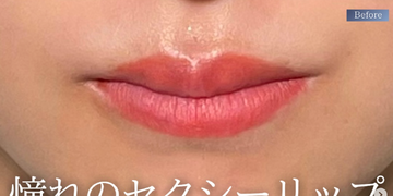 PRISM Beauty Clinicの口元の症例写真[ビフォー]