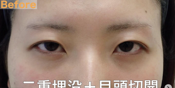 ニドークリニック 名古屋の目・二重整形の症例写真[ビフォー]