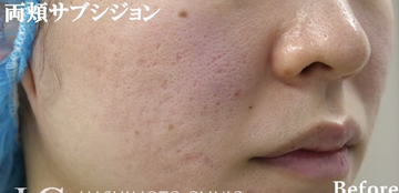 静岡美容外科橋本クリニックのニキビ・ニキビ跡の治療の症例写真[ビフォー]