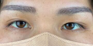 AI Beauty Clinicの二重の症例写真[ビフォー]