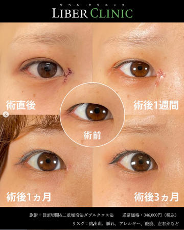 LIBER CLINIC （リベルクリニック）の目・二重整形の症例写真