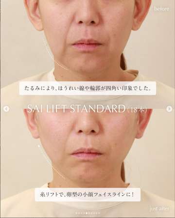 SAI CLINIC （サイクリニック）のリフトアップの症例写真