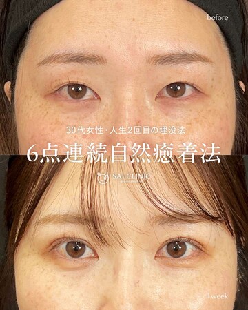 SAI CLINIC （サイクリニック）の二重の症例写真