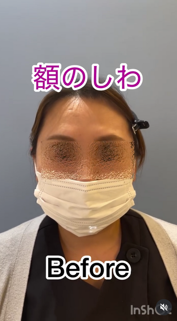 みやもと美容クリニックのしわ・たるみ整形(注入、糸、フェイスリフト)の症例写真[ビフォー]