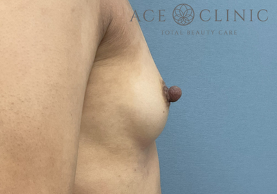 乳頭縮小症の症例写真[ビフォー]