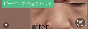 やさしい美容皮膚科・皮フ科 秋葉原院/シミレーザー東京の症例写真[アフター]
