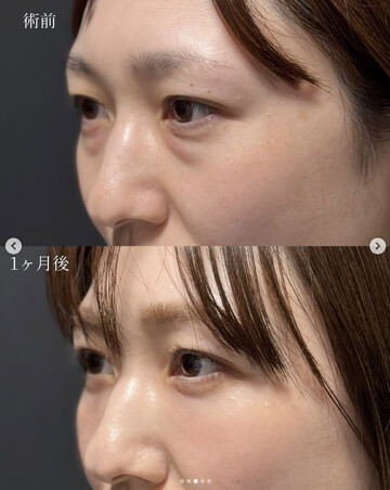 CLINIC Wの目元・クマ・眉下・涙袋整形の症例写真