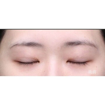 聖心美容クリニックの二重の症例写真[ビフォー]