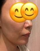 ペルラクリニック神宮前のリフトアップの症例写真[ビフォー]