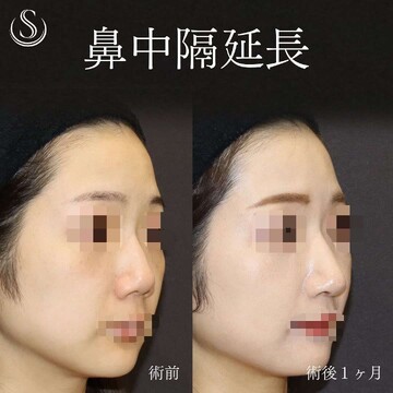 聖心美容クリニックの鼻の整形の症例写真