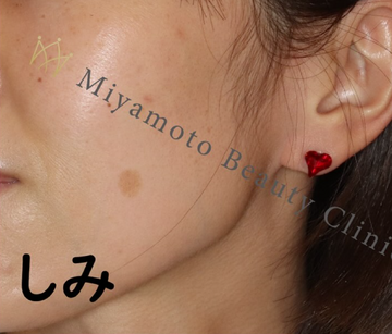 みやもと美容クリニックのシミ取り・肝斑・毛穴治療の症例写真[ビフォー]