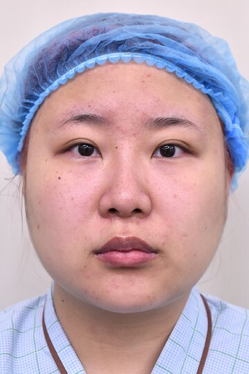 医療法人秀晄会 心斎橋コムロ美容外科クリニックの脂肪吸引の症例写真[ビフォー]