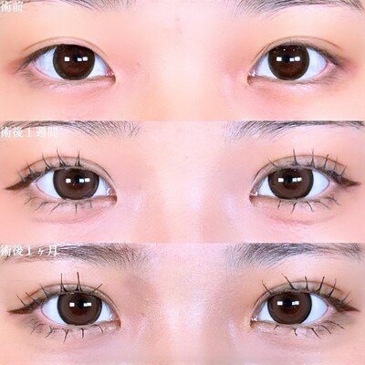 アリエルクイックループダブル二重埋没法の症例写真