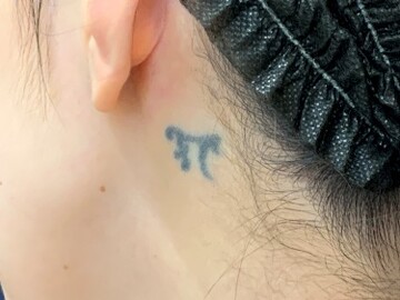 タウン形成外科クリニックのタトゥー除去の症例写真[ビフォー]