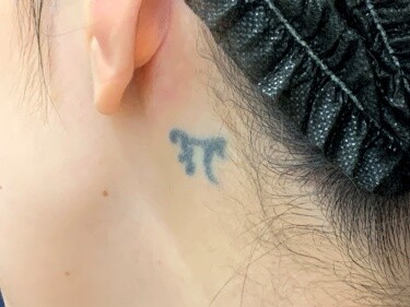 刺青（タトゥー）除去（切縫法）の症例写真[ビフォー]