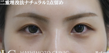 静岡美容外科橋本クリニックの二重の症例写真[ビフォー]