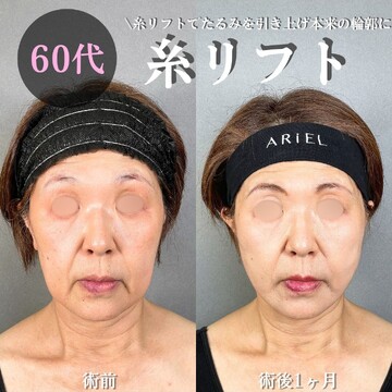 アリエル美容クリニック 大宮院のしわ・たるみ整形(注入、糸、フェイスリフト)の症例写真