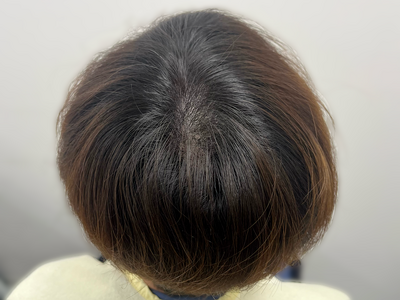 ヘアアートメイク｜40代｜2回の症例写真[アフター]