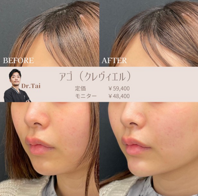 アゴヒアルロン酸(クレヴィエル)の症例写真