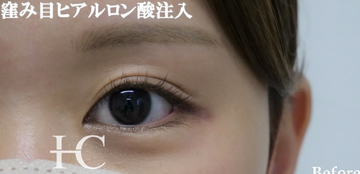 静岡美容外科橋本クリニックのしわ・たるみ整形(注入、糸、フェイスリフト)の症例写真[ビフォー]
