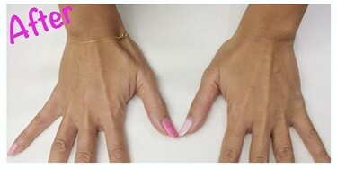 手の甲アンチエイジング ヒアルロン酸注入 ヒアルロン酸注入 シワ たるみ治療 の症例写真 画像 ノエル銀座クリニック Cs 美容医療の口コミ広場