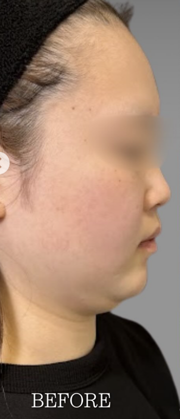 Plume Clinicの脂肪吸引の症例写真[ビフォー]