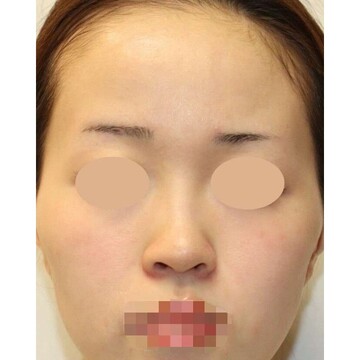 聖心美容クリニックの鼻の症例写真[ビフォー]