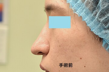 医療法人秀晄会 心斎橋コムロ美容外科クリニックの鼻の整形の症例写真[ビフォー]