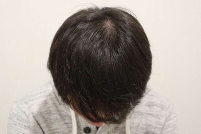 Rebirth+ミノキジェット｜20代｜4か月の症例写真[アフター]
