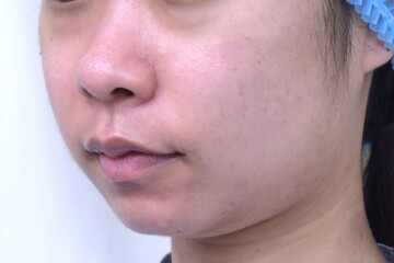 医療法人秀晄会 心斎橋コムロ美容外科クリニックの脂肪吸引の症例写真[ビフォー]
