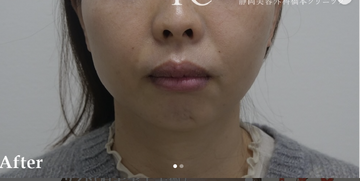 静岡美容外科橋本クリニックの症例写真[アフター]