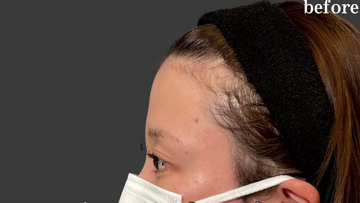 Plume Clinicの輪郭・顎・エラ・額・小顔整形の症例写真[ビフォー]