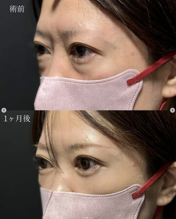 CLINIC Wの目元・クマ・眉下・涙袋整形の症例写真