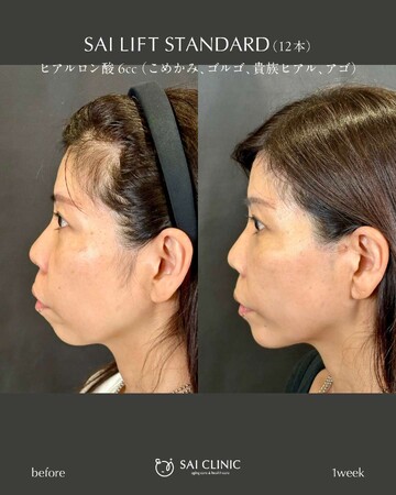 SAI CLINIC （サイクリニック）のリフトアップの症例写真