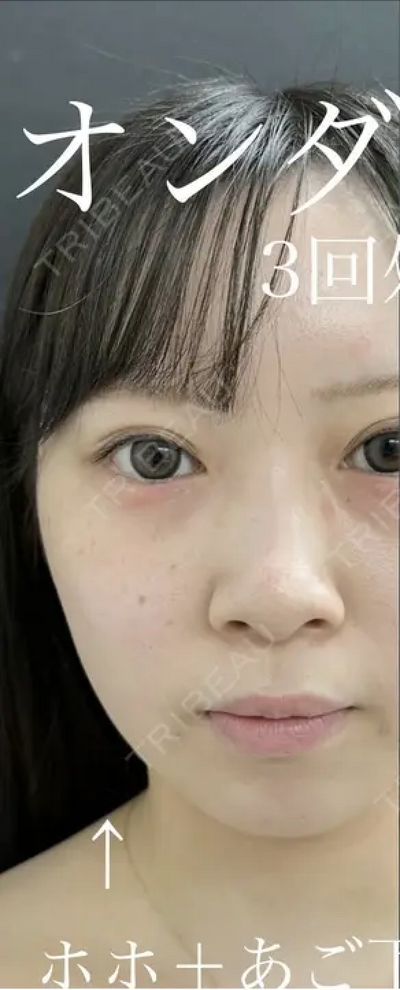 オンダリフトの症例写真[ビフォー]
