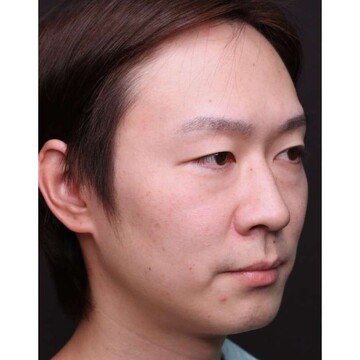 聖心美容クリニックの目元の症例写真[ビフォー]